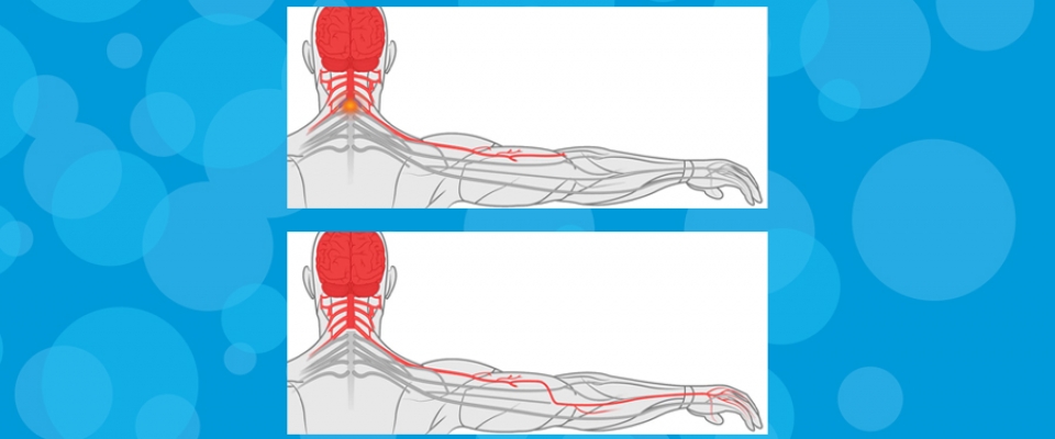 Rehabilitation After Nerve Transfer Figure