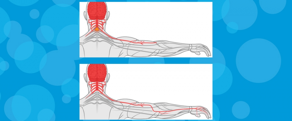 Cervical Spinal Cord Injury