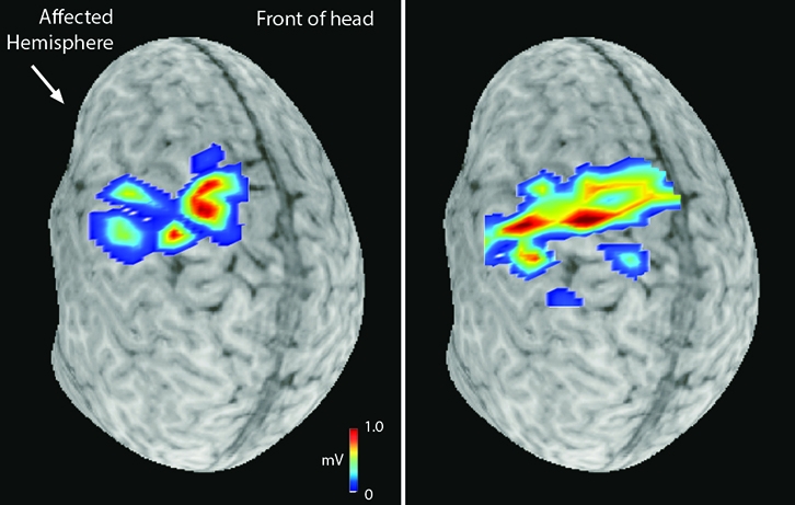 Effects of hand rehabilitative training on the motor representation of the impaired hand in a child with CP. Effects of hand rehabilitative training on the motor representation of the impaired hand in a child with CP.