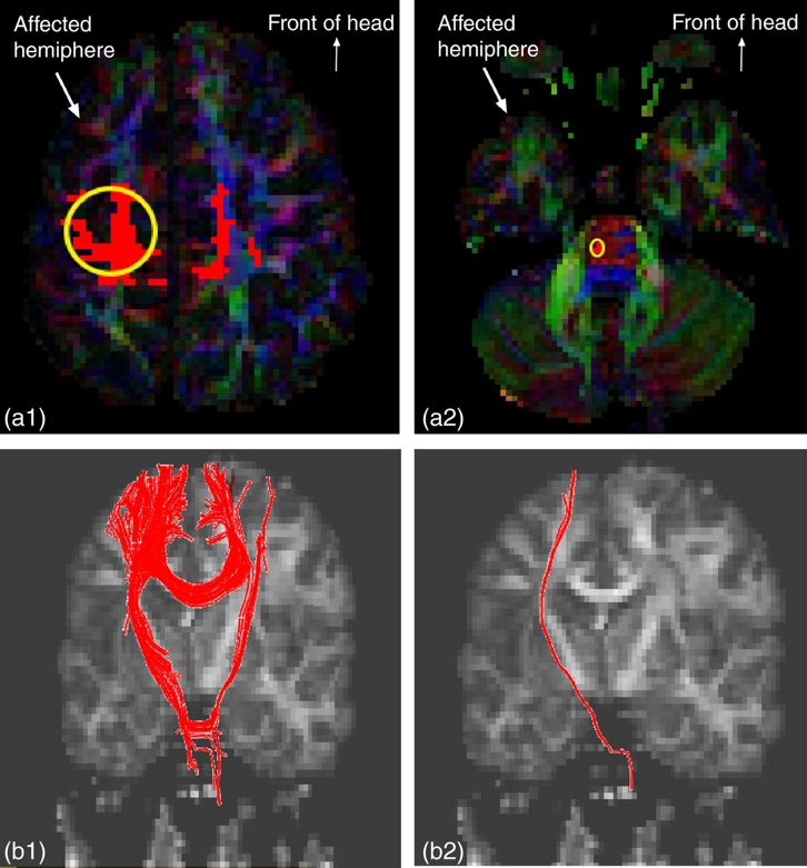 Diffusion Tensor Imaging (DTI) in children with CP. Diffusion Tensor Imaging (DTI) in children with CP.