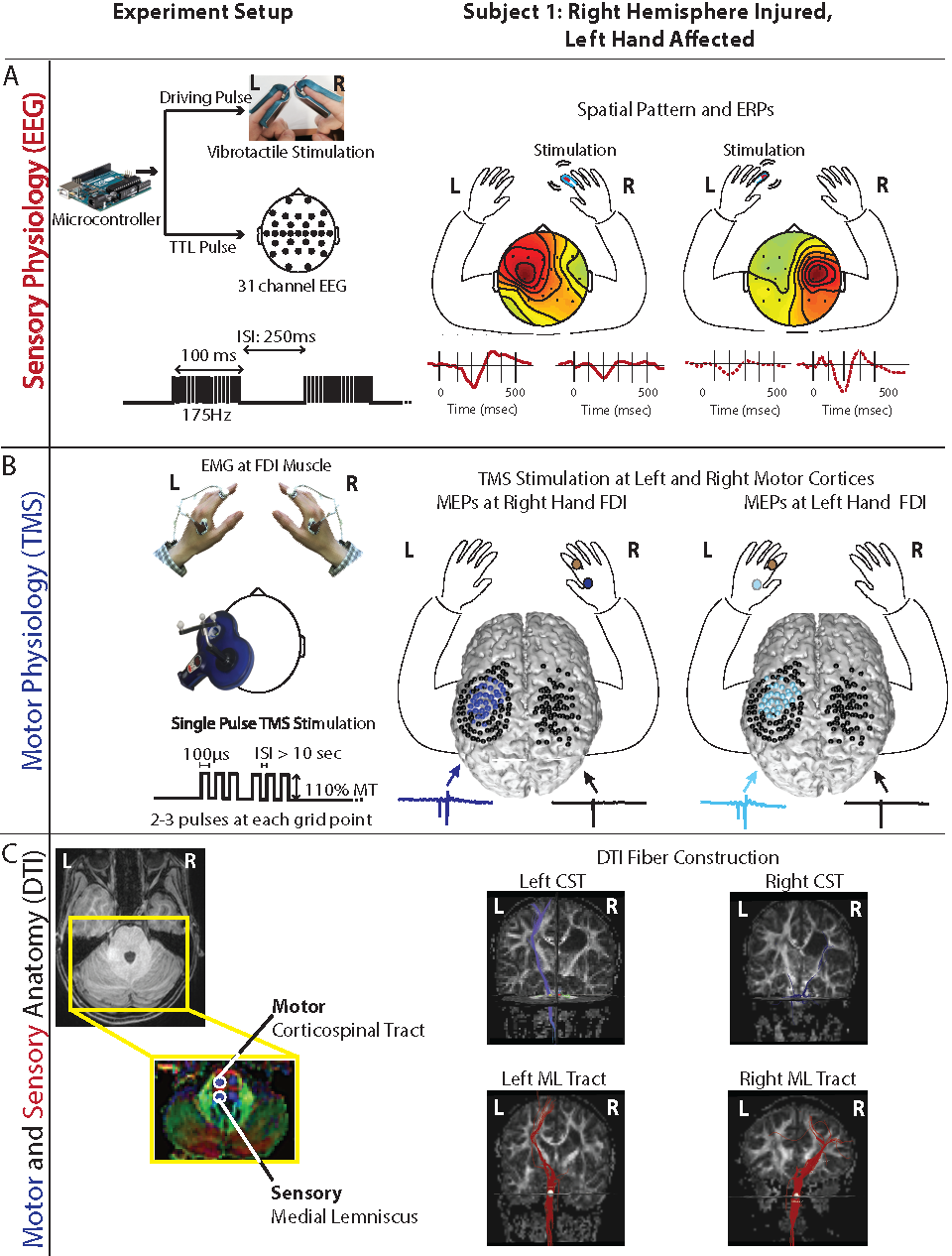 Researchers Discover a Novel Factor in Restoring Hand Function in Children with Cerebral Palsy